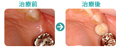 インプラント治療施術前後写真