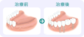 数本の歯を失った場合