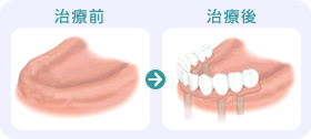 全ての歯を失った場合