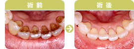 ホワイトニング術前・術後写真