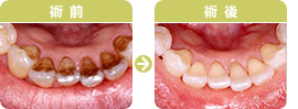 歯のクリーニング術前・術後写真